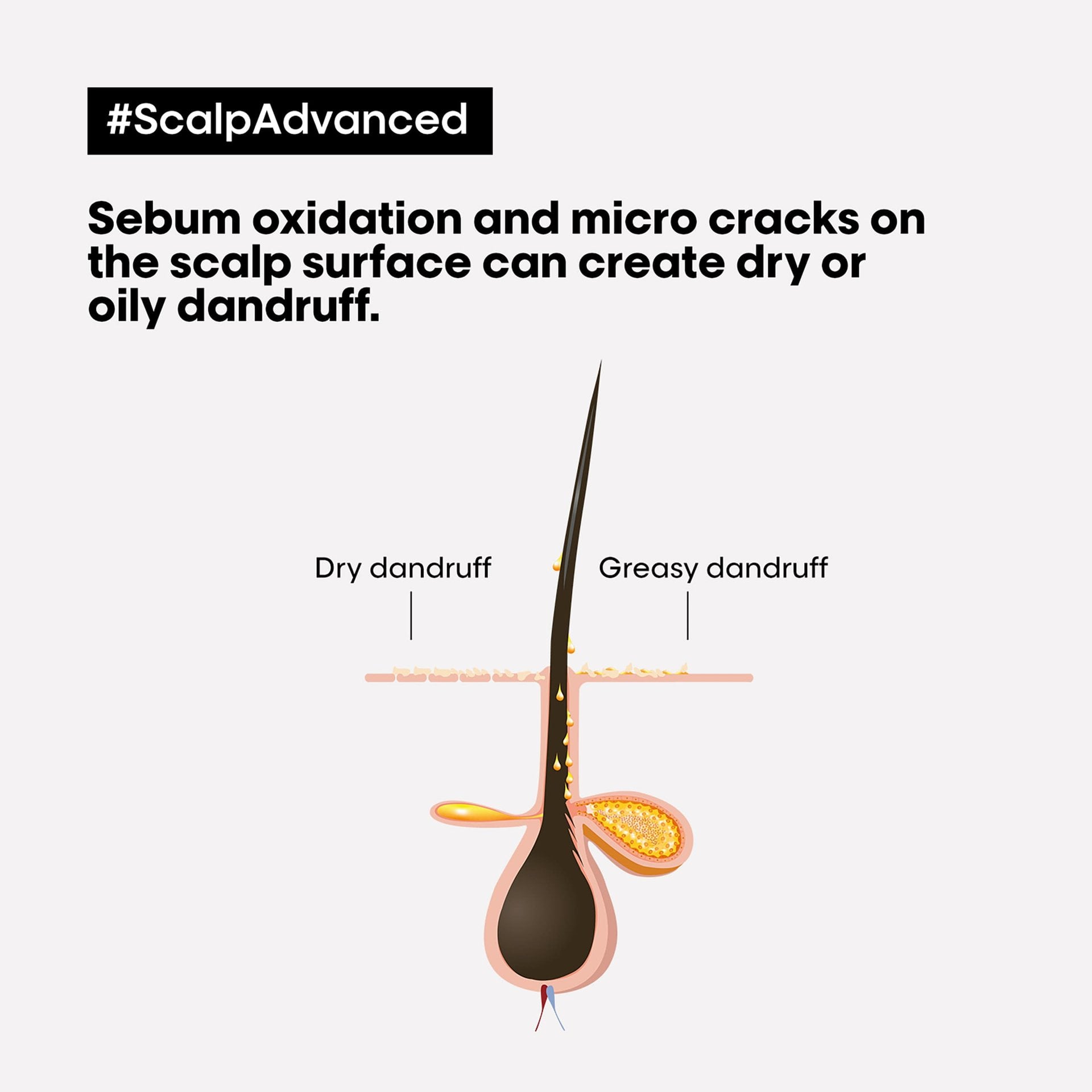 Anti-dandruff dermo-clarifier shampoo.
